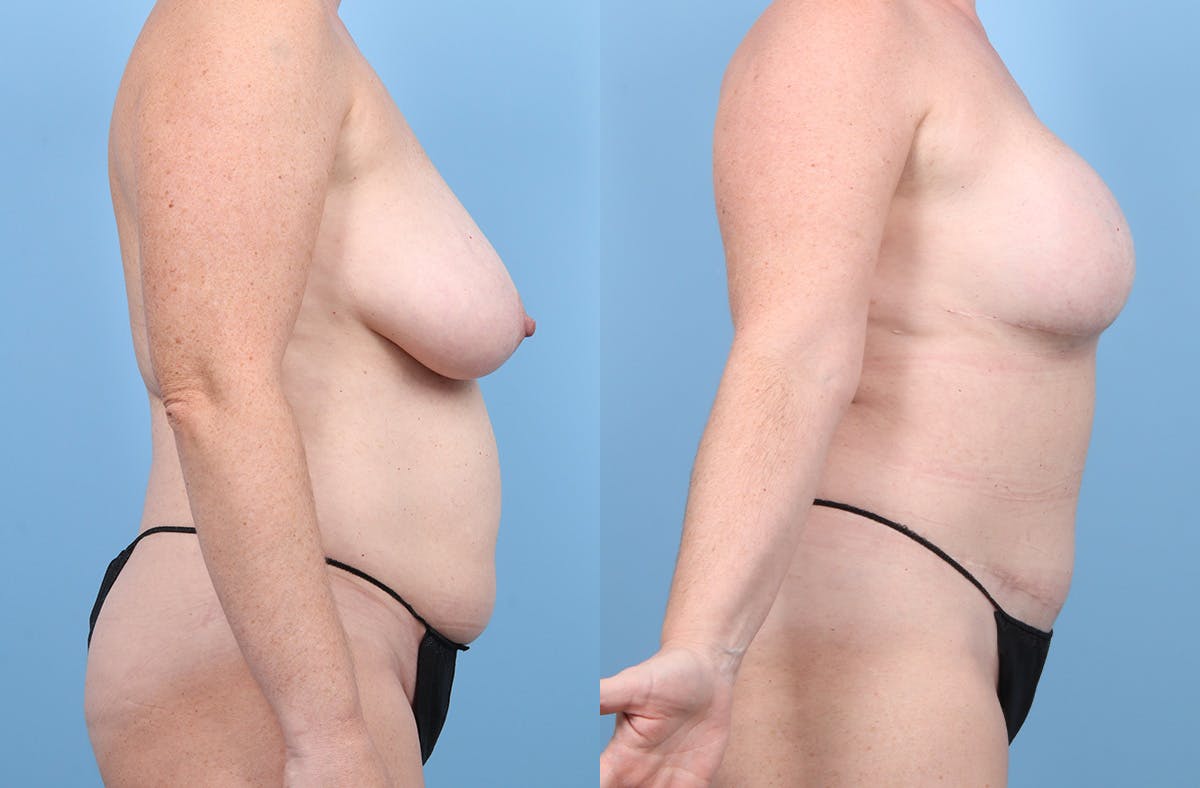DIEP Flap Reconstruction Before & After Gallery - Patient 405285 - Image 4