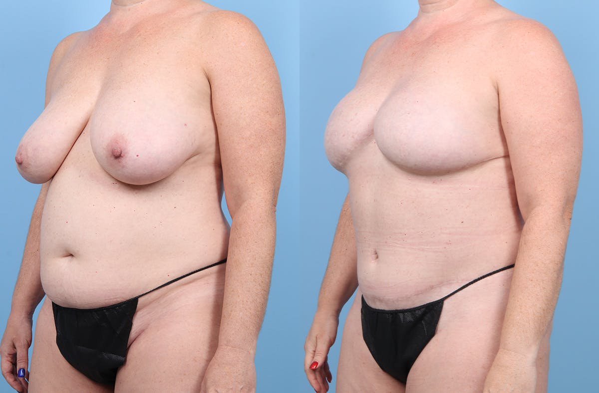 DIEP Flap Reconstruction Before & After Gallery - Patient 405285 - Image 5