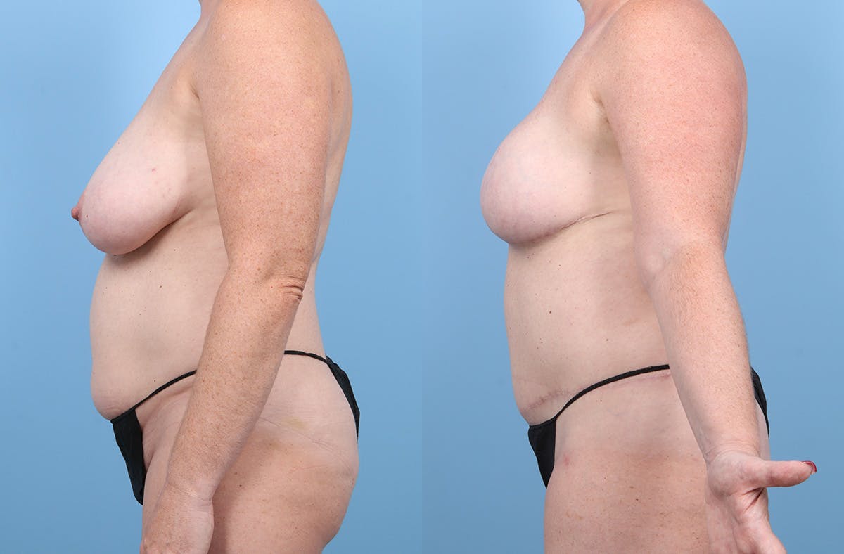 DIEP Flap Reconstruction Before & After Gallery - Patient 405285 - Image 6