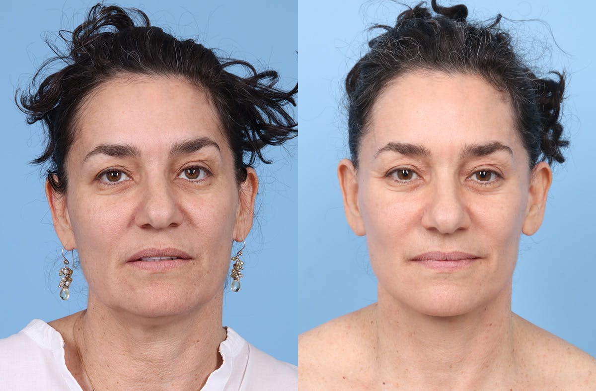 Facial Fat Grafting Before & After Gallery - Patient 246777 - Image 1
