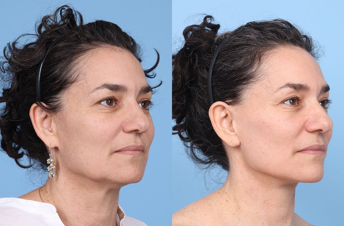 Facial Fat Grafting Before & After Gallery - Patient 246777 - Image 2