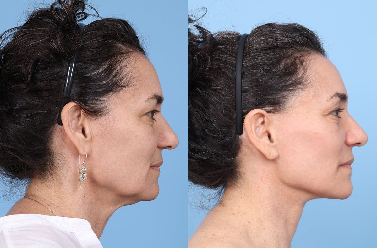 Facial Fat Grafting Before & After Gallery - Patient 246777 - Image 3