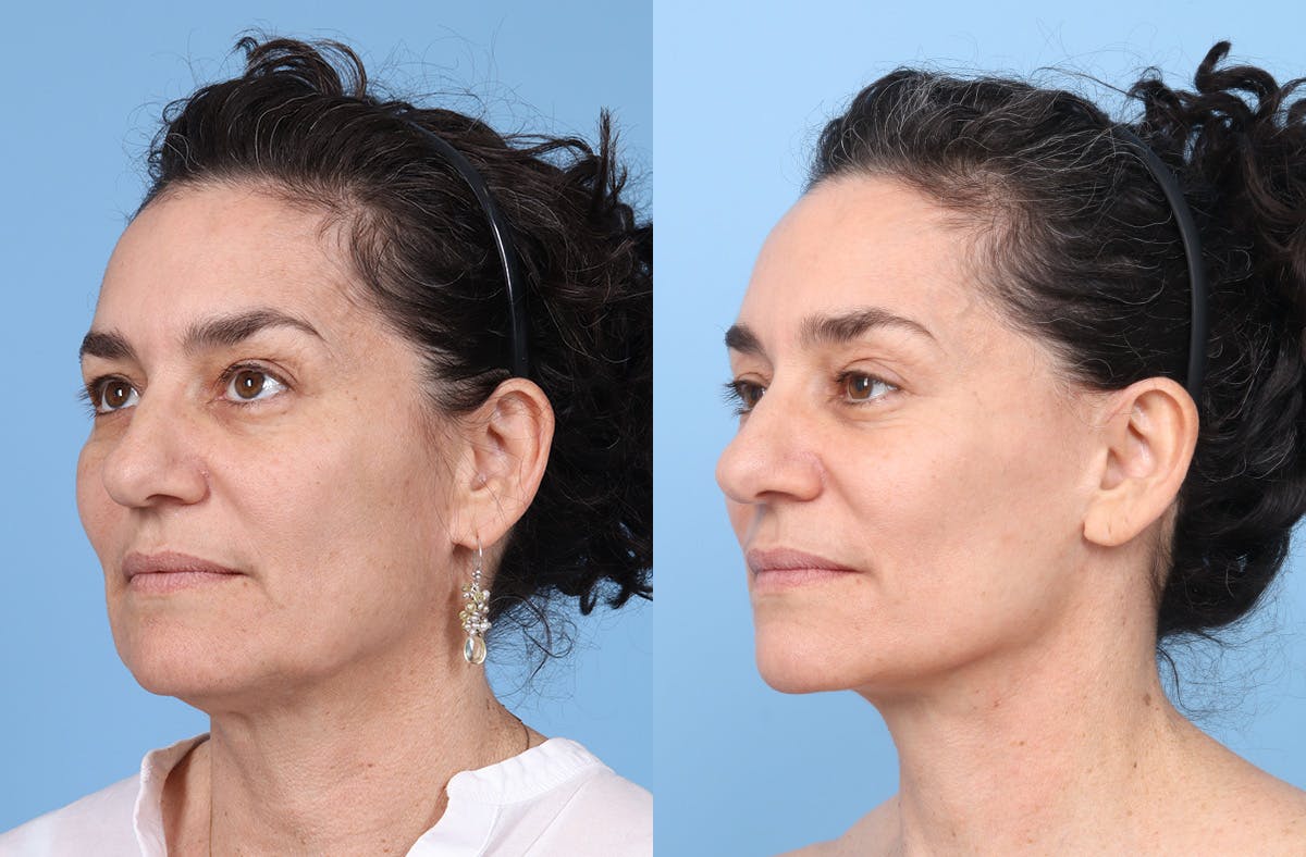 Facial Fat Grafting Before & After Gallery - Patient 246777 - Image 4