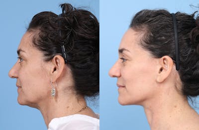 Neck Lift Before & After Gallery - Patient 309540 - Image 1