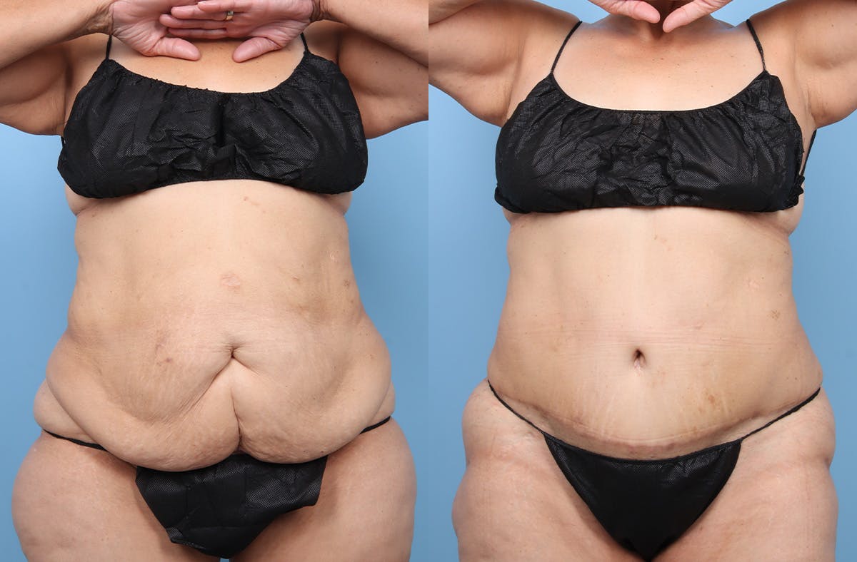Tummy Tuck Before & After Gallery - Patient 341010 - Image 1