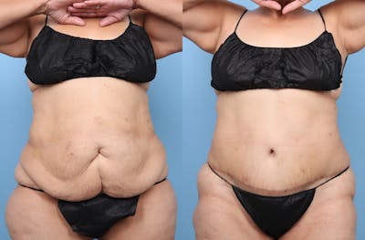 Tummy Tuck Before & After Gallery - Patient 341010 - Image 1