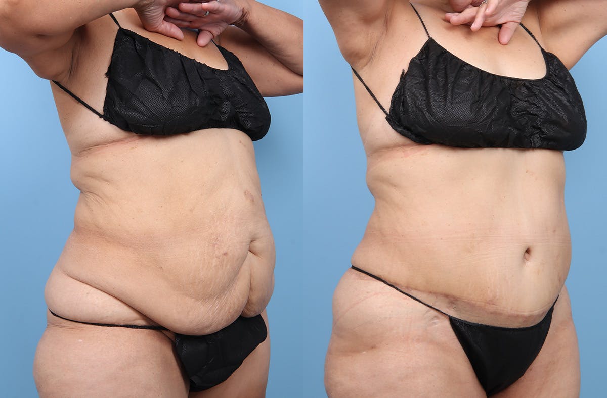 Tummy Tuck Before & After Gallery - Patient 341010 - Image 2