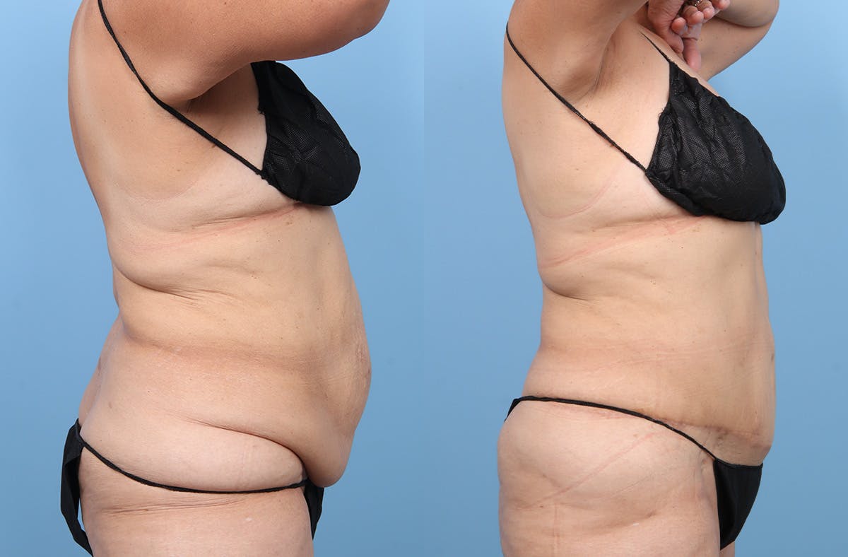 Tummy Tuck Before & After Gallery - Patient 341010 - Image 3
