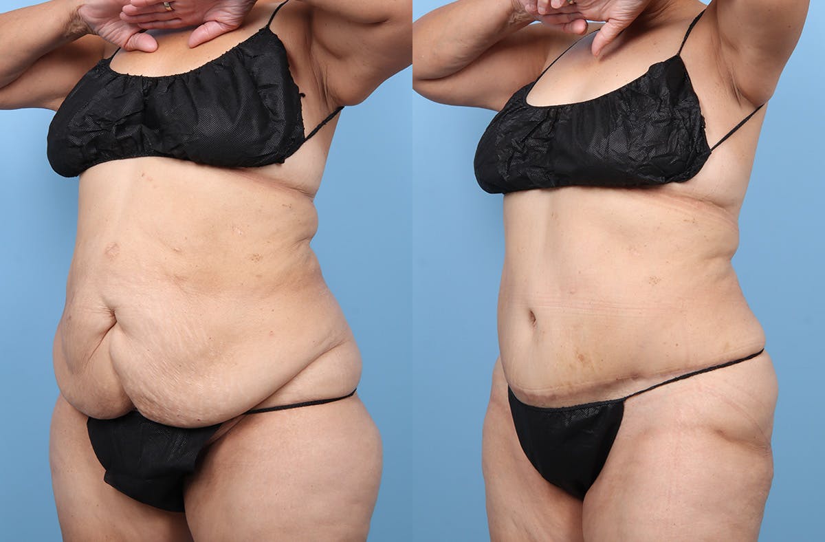 Tummy Tuck Before & After Gallery - Patient 341010 - Image 4