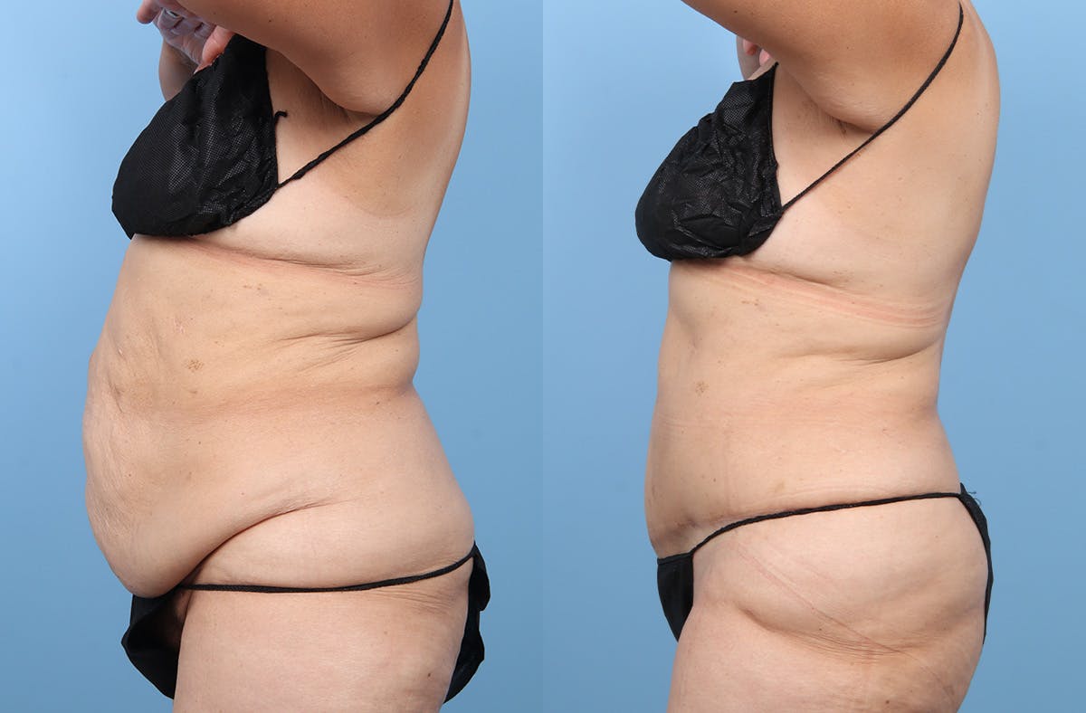 Tummy Tuck Before & After Gallery - Patient 341010 - Image 5