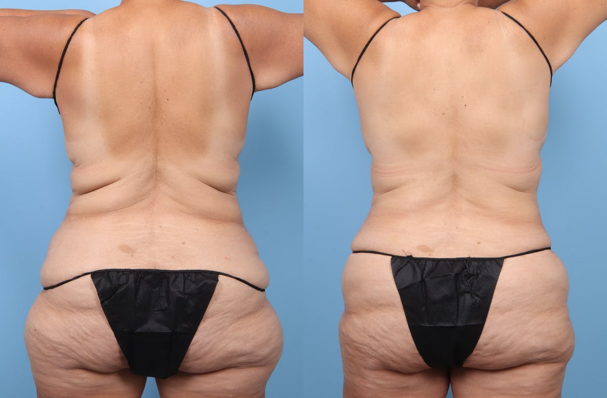 Tummy Tuck Before & After Gallery - Patient 341010 - Image 6