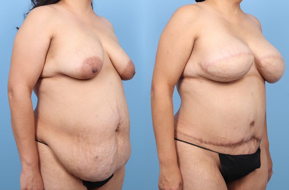 DIEP Flap Reconstruction Before & After Gallery - Patient 117270 - Image 2
