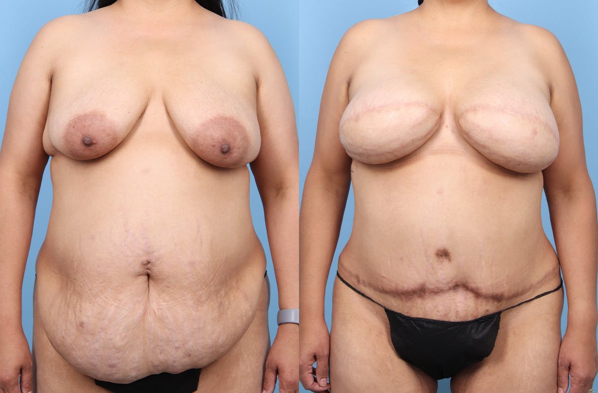 DIEP Flap Reconstruction Before & After Gallery - Patient 117270 - Image 1