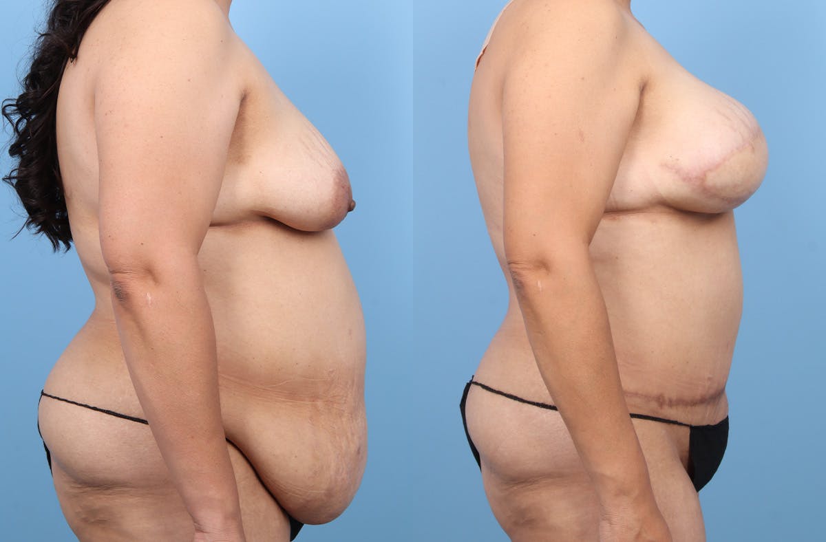 DIEP Flap Reconstruction Before & After Gallery - Patient 117270 - Image 3