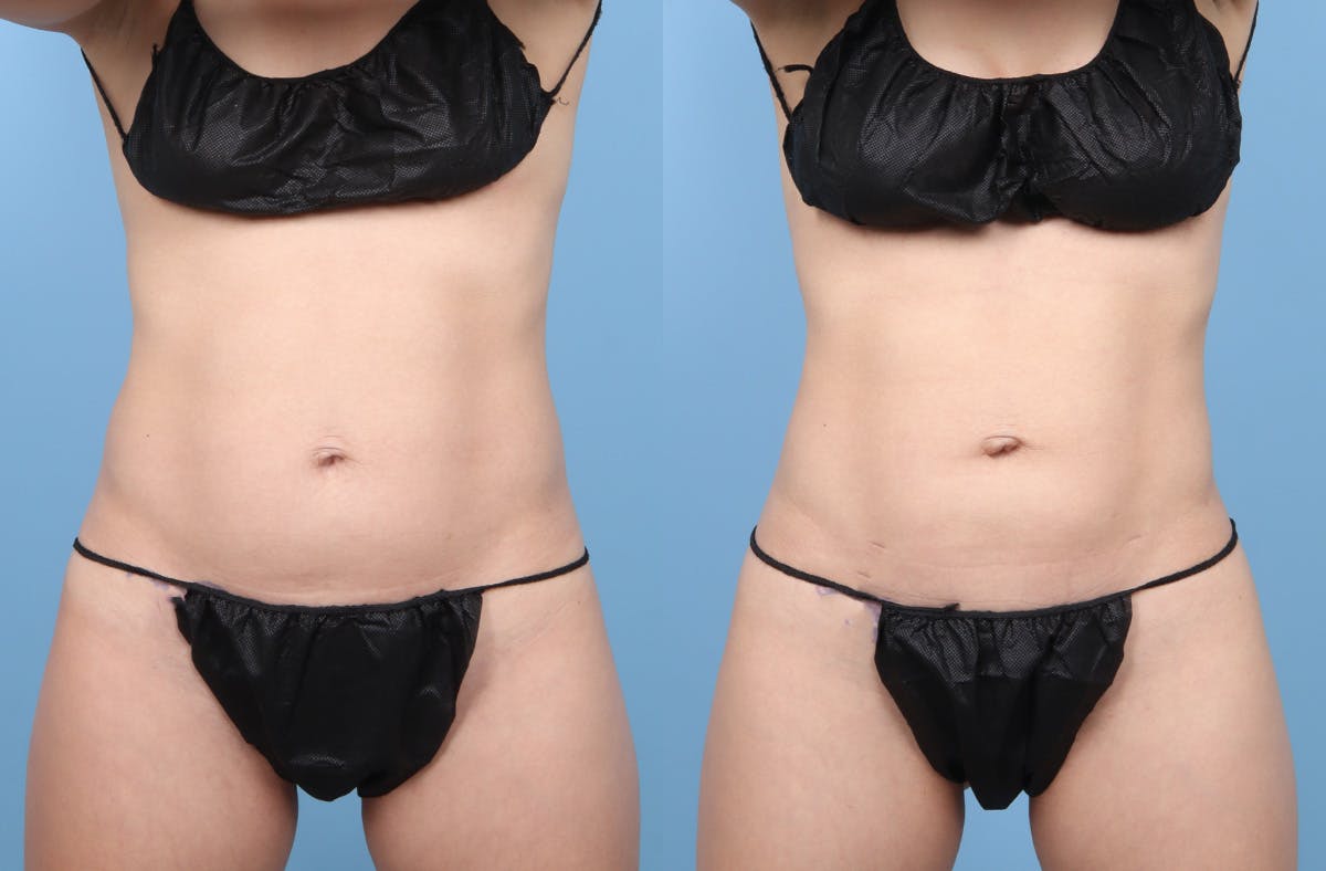 Liposuction Before & After Gallery - Patient 311697 - Image 1
