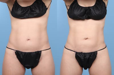 Liposuction Before & After Gallery - Patient 311697 - Image 1