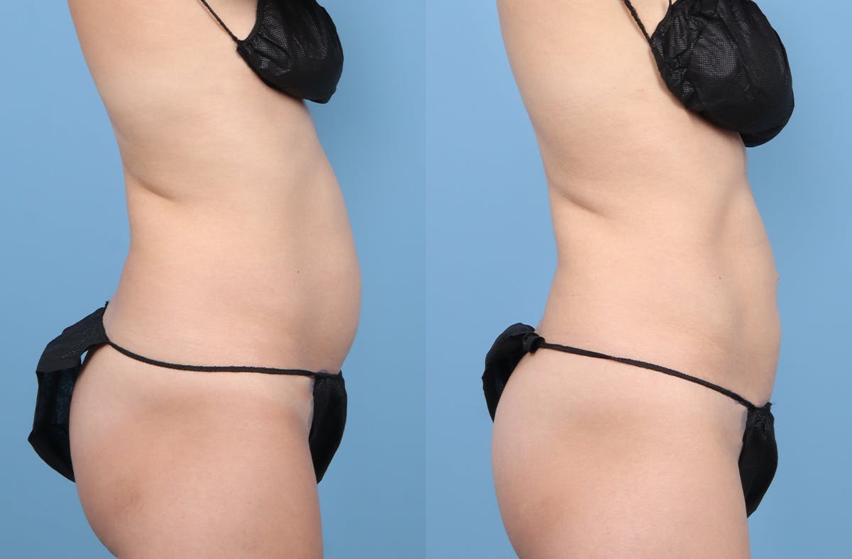 Liposuction Before & After Gallery - Patient 311697 - Image 3