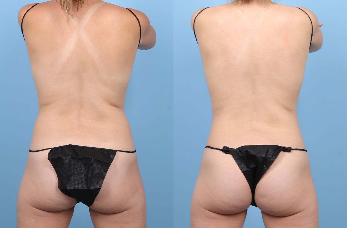 Liposuction Before & After Gallery - Patient 311697 - Image 4