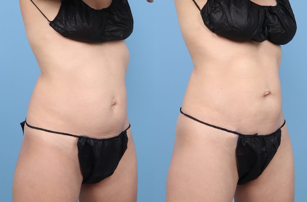 Liposuction Before & After Gallery - Patient 311697 - Image 2