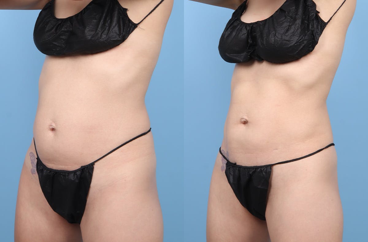 Liposuction Before & After Gallery - Patient 311697 - Image 5