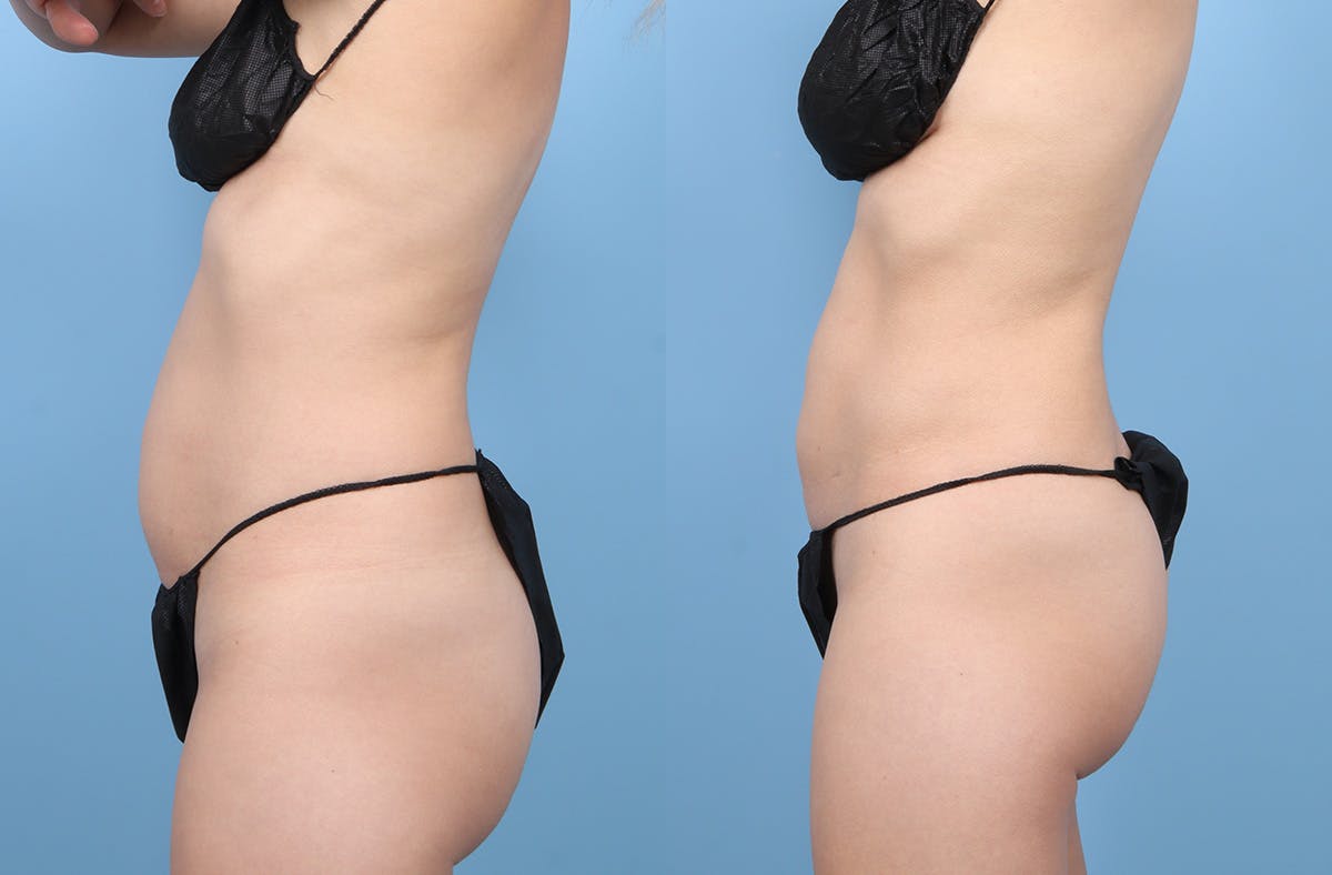 Liposuction Before & After Gallery - Patient 311697 - Image 6