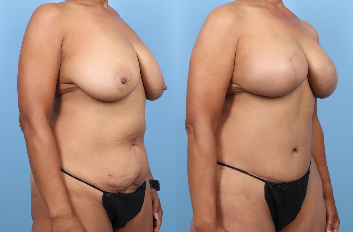 DIEP Flap Reconstruction Before & After Gallery - Patient 307005 - Image 2
