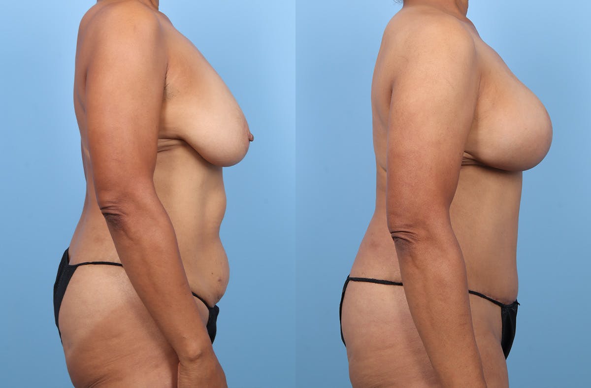 DIEP Flap Reconstruction Before & After Gallery - Patient 307005 - Image 3
