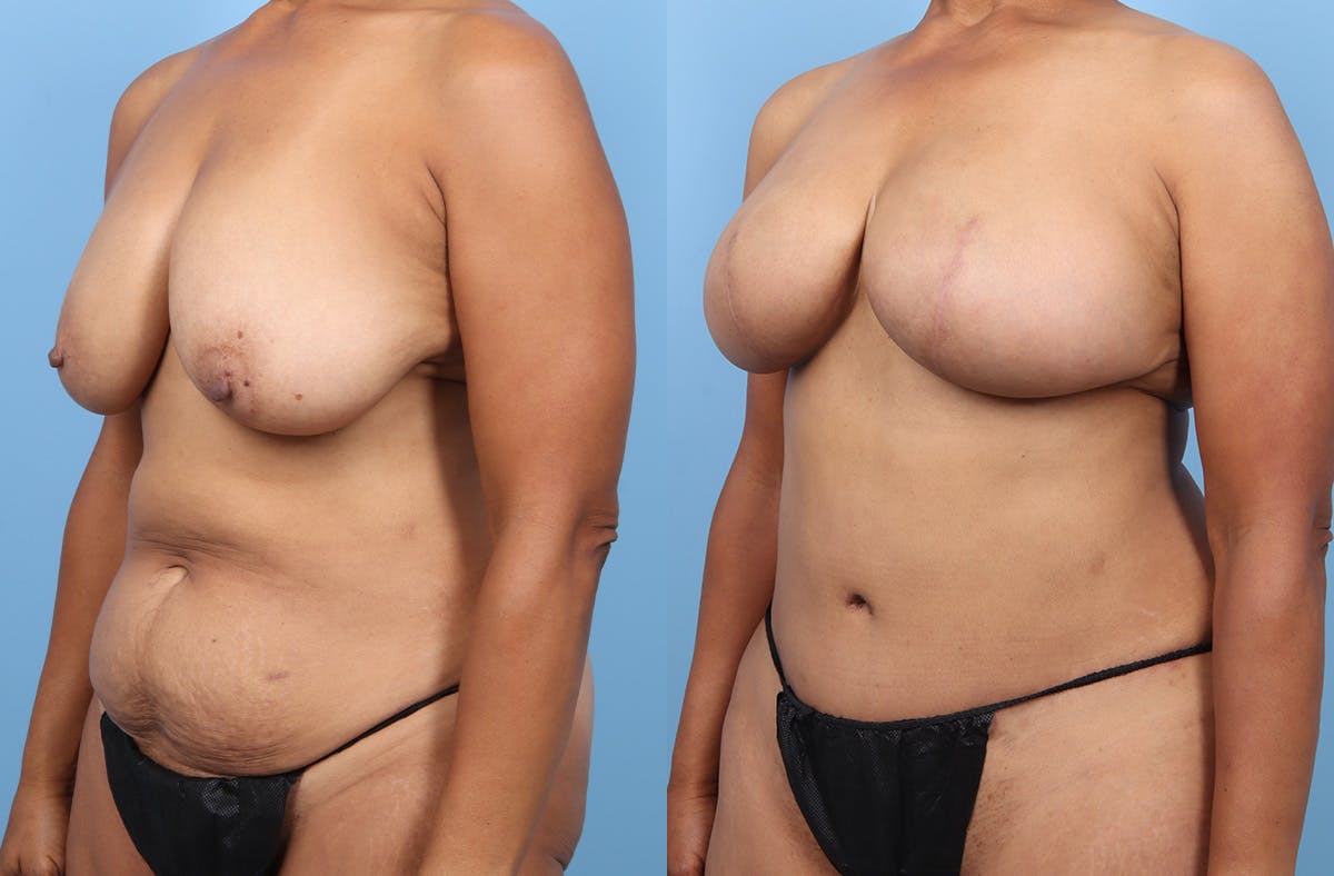 DIEP Flap Reconstruction Before & After Gallery - Patient 307005 - Image 4