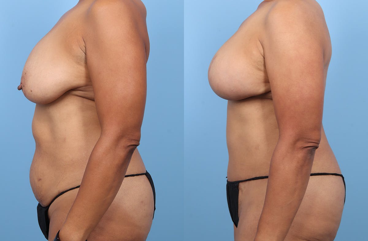DIEP Flap Reconstruction Before & After Gallery - Patient 307005 - Image 5