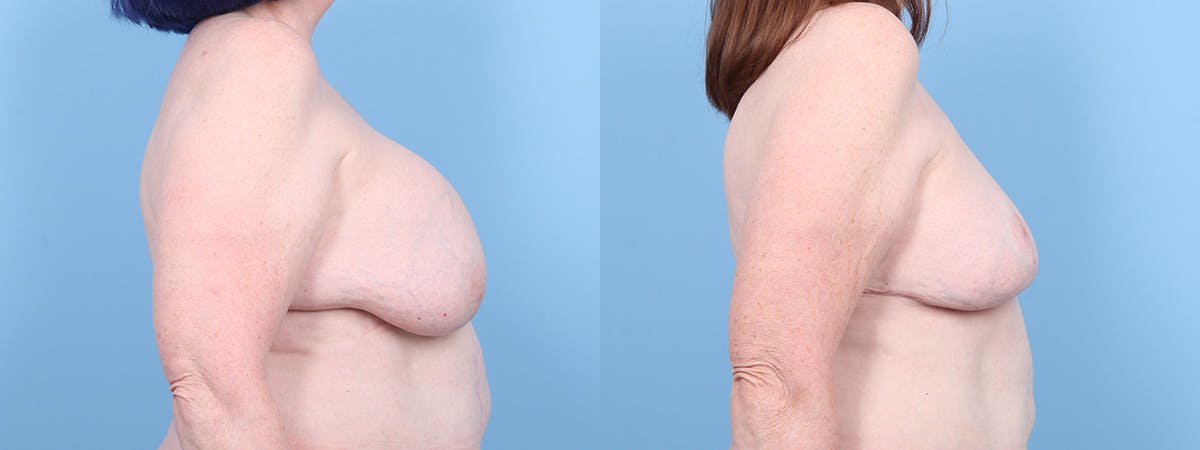 Implant Removal w/ Fat Grafting Before & After Gallery - Patient 391546 - Image 3