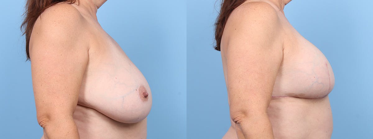 Direct to Implant Reconstruction Before & After Gallery - Patient 345452 - Image 3