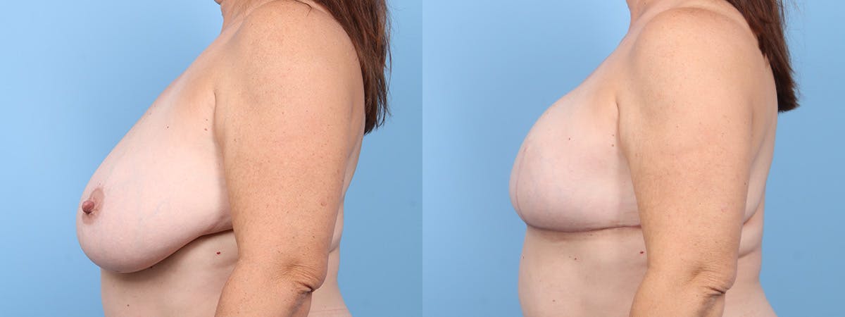 Direct to Implant Reconstruction Before & After Gallery - Patient 345452 - Image 5
