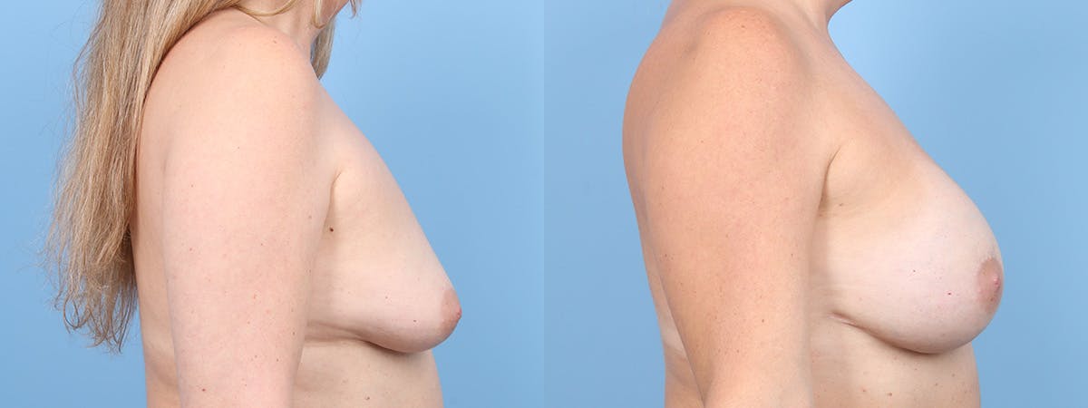 Direct to Implant Reconstruction Before & After Gallery - Patient 470038 - Image 3