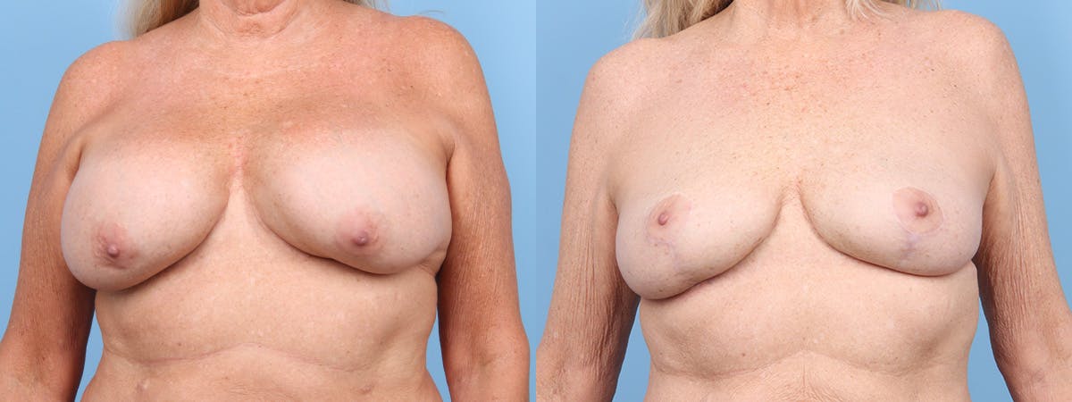 Implant Removal Before & After Gallery - Patient 232611 - Image 1