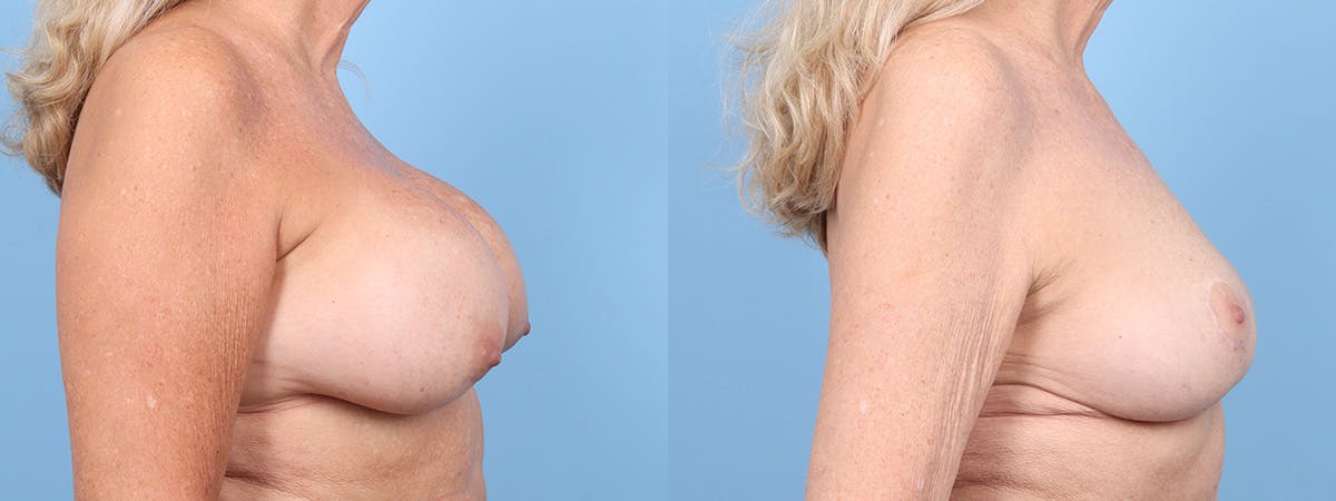 Implant Removal Before & After Gallery - Patient 232611 - Image 3