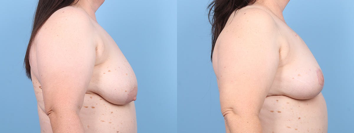 Oncoplastic Reconstruction Before & After Gallery - Patient 169656 - Image 3