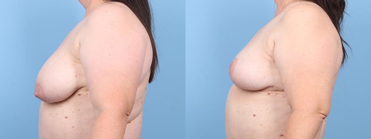 Oncoplastic Reconstruction Before & After Gallery - Patient 169656 - Image 5