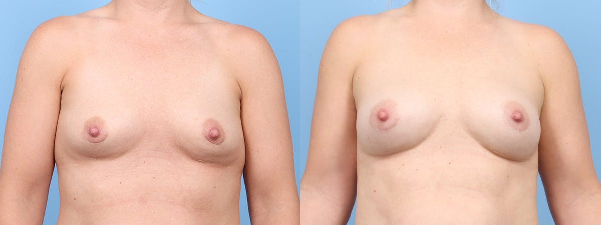 Implant Removal w/ Fat Grafting Before & After Gallery - Patient 201632 - Image 1