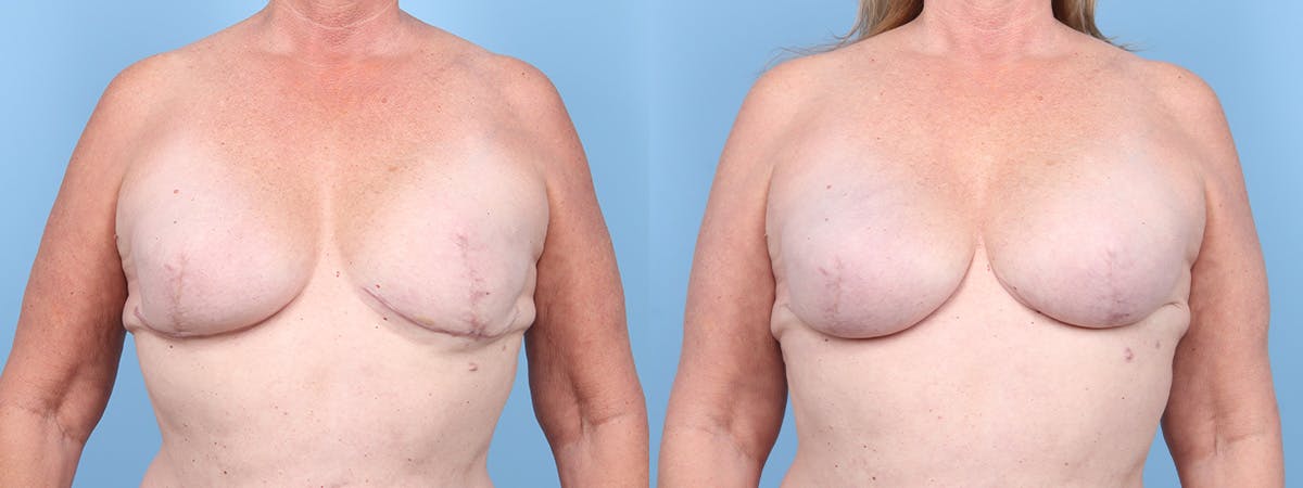 Implant Reconstruction Revision Before & After Gallery - Patient 129354 - Image 1