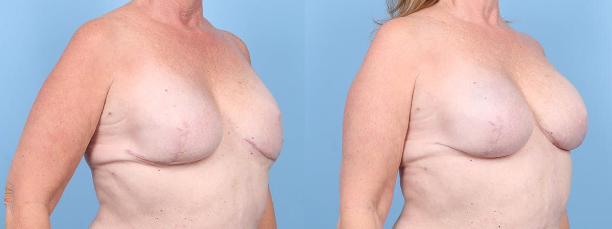 Implant Reconstruction Revision Before & After Gallery - Patient 129354 - Image 2