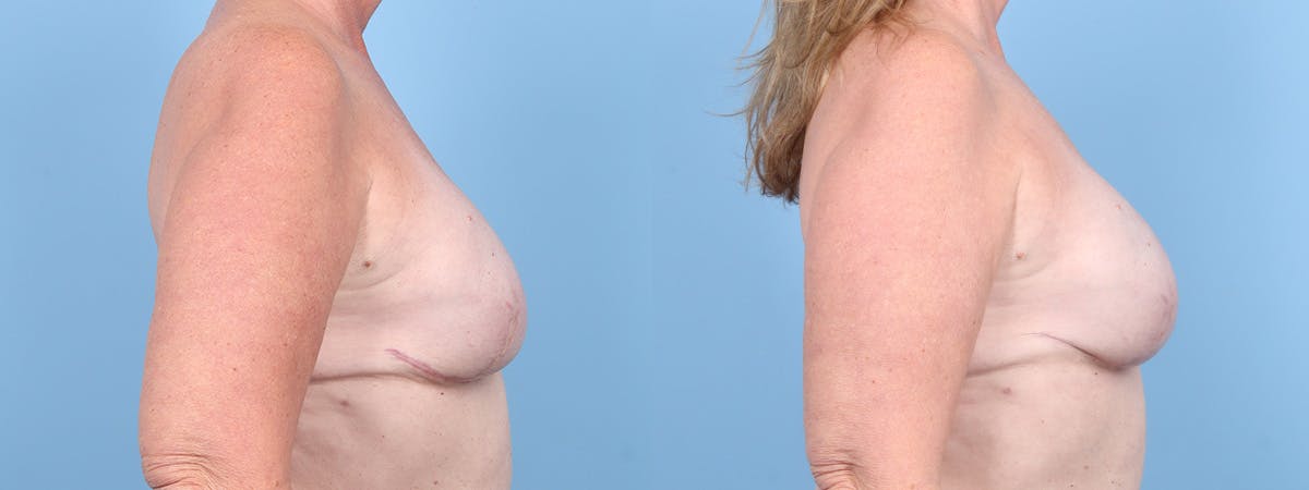 Implant Reconstruction Revision Before & After Gallery - Patient 129354 - Image 3