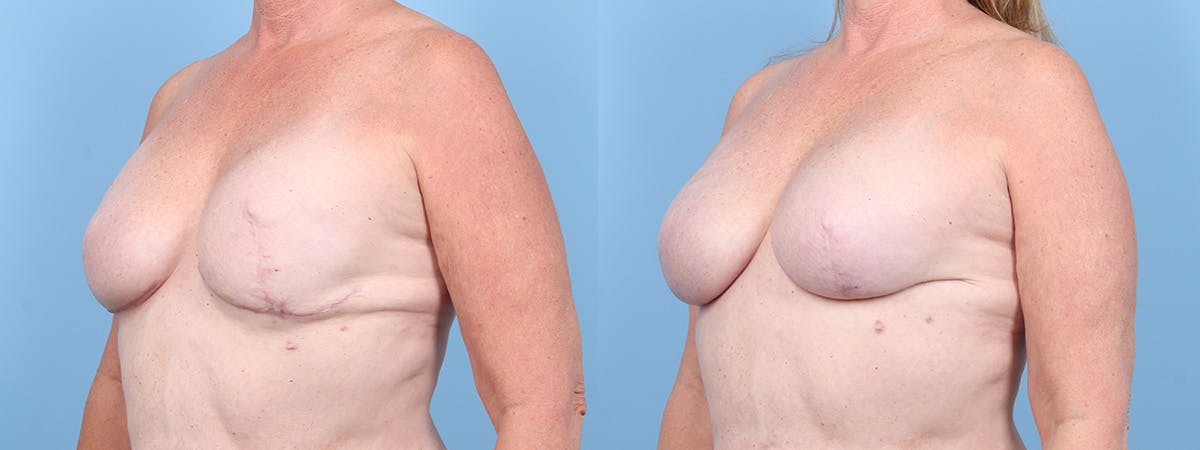 Implant Reconstruction Revision Before & After Gallery - Patient 129354 - Image 4