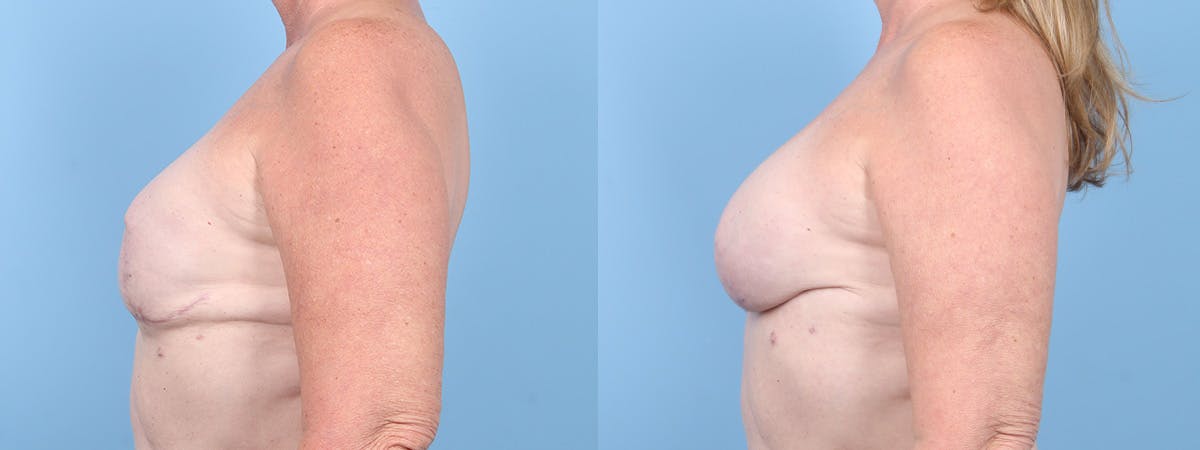 Implant Reconstruction Revision Before & After Gallery - Patient 129354 - Image 5