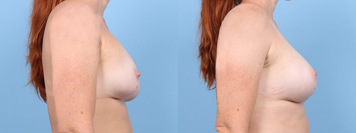 Implant Revision Before & After Gallery - Patient 238924 - Image 3