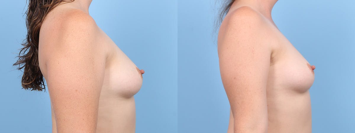 Direct to Implant Reconstruction Before & After Gallery - Patient 205327 - Image 3