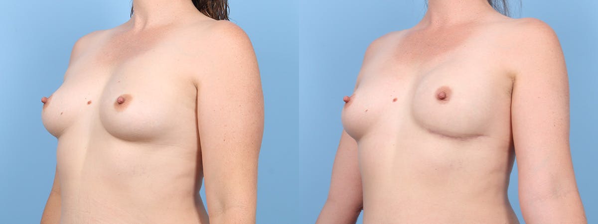 Direct to Implant Reconstruction Before & After Gallery - Patient 205327 - Image 4