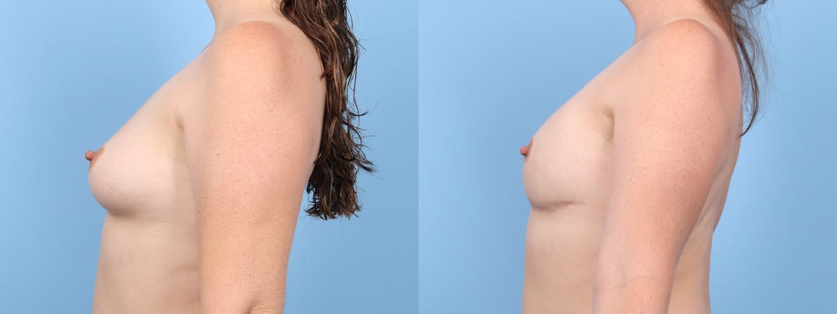 Direct to Implant Reconstruction Before & After Gallery - Patient 205327 - Image 5
