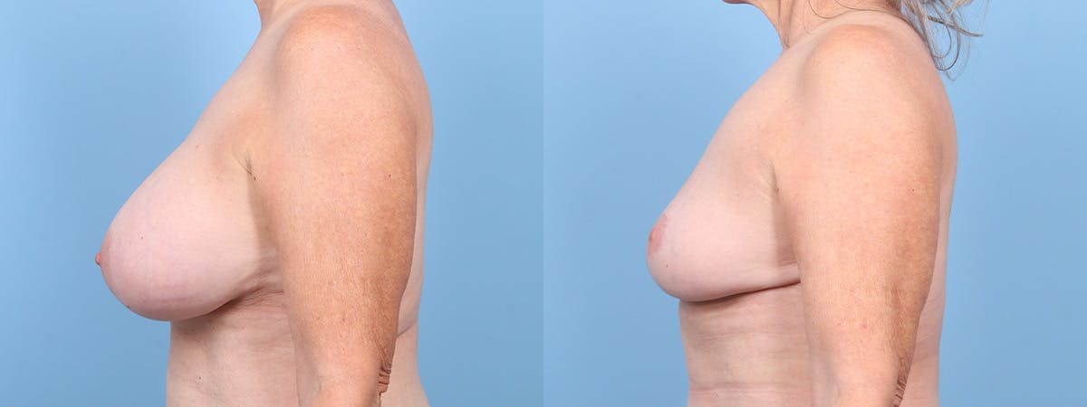 Implant Removal w/ Fat Grafting Before & After Gallery - Patient 308724 - Image 5