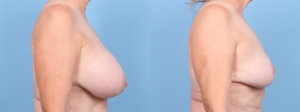 Implant Removal w/ Fat Grafting Before & After Gallery - Patient 308724 - Image 3