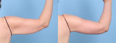 Arm Lift (Brachioplasty) Before & After Gallery - Patient 297785 - Image 1